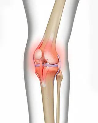img-cirugia-de-ligamento-cruzado-en-bogota-1-LCP