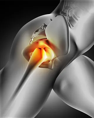 img-hip-replacement-surgery-in-bogota-1-LCP
